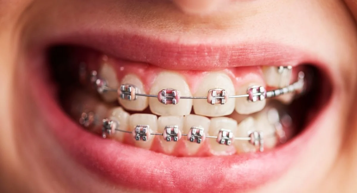 How Long Do Kids Usually Wear Braces